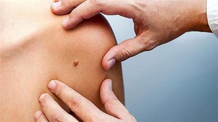 6 signs that indicate the possibility of skin cancer